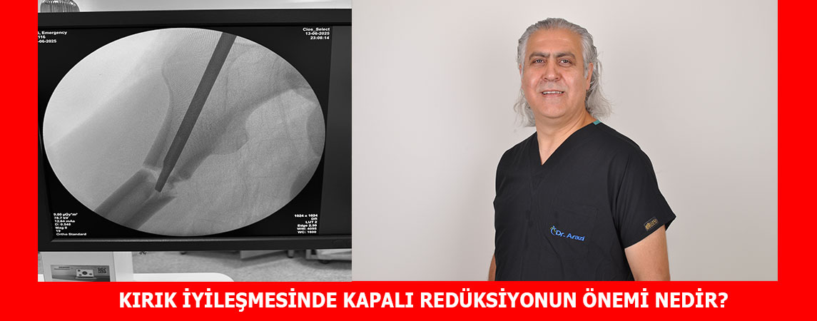 KIRIK İYİLEŞMESİNDE KAPALI REDÜKSİYONUN ÖNEMİ NEDİR?